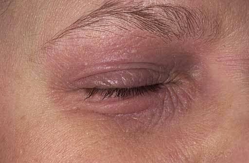 Eczema Around Eyes Causing Wrinkles